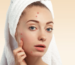 Skin Care Routine for Acne-Prone Skin