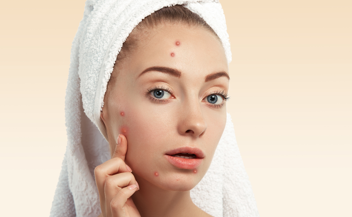 Skin Care Routine for Acne-Prone Skin